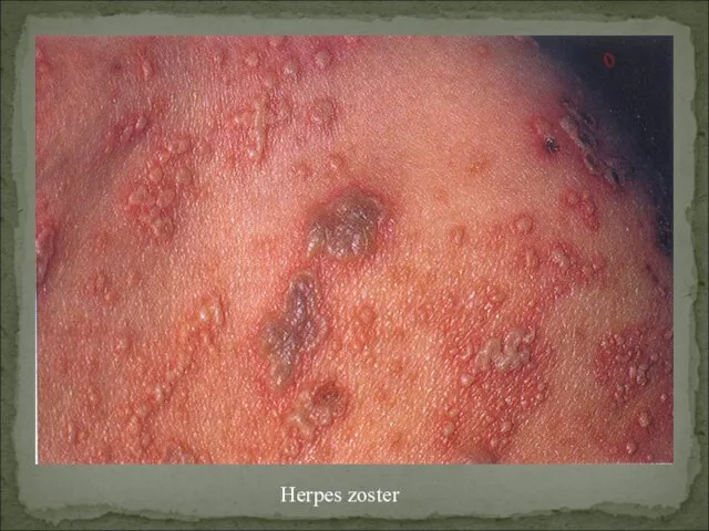 Herpes zoster