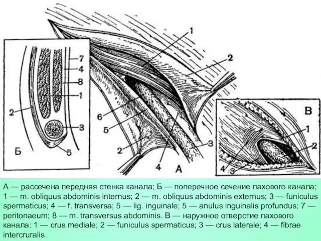 А — рассечена передняя стенка канала; Б — поперечное сечение пахового