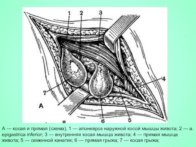 А — косая и прямая (схема), 1 — апоневроз наружной косой