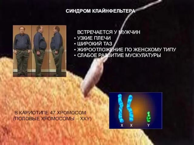 СИНДРОМ КЛАЙНФЕЛЬТЕРА ВСТРЕЧАЕТСЯ У МУЖЧИН УЗКИЕ ПЛЕЧИ ШИРОКИЙ ТАЗ ЖИРООТЛОЖЕНИЕ ПО