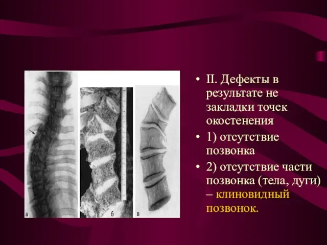 II. Дефекты в результате не закладки точек окостенения 1) отсутствие позвонка