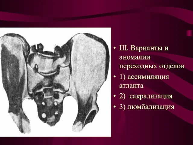 III. Варианты и аномалии переходных отделов 1) ассимиляция атланта 2) сакрализация 3) люмбализация