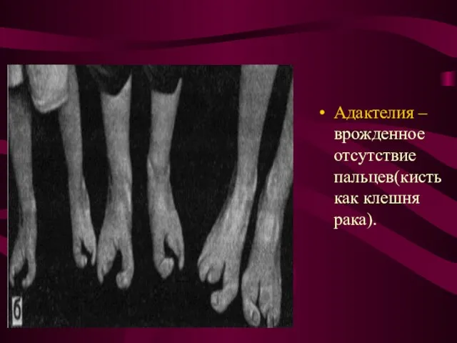 Адактелия – врожденное отсутствие пальцев(кисть как клешня рака).