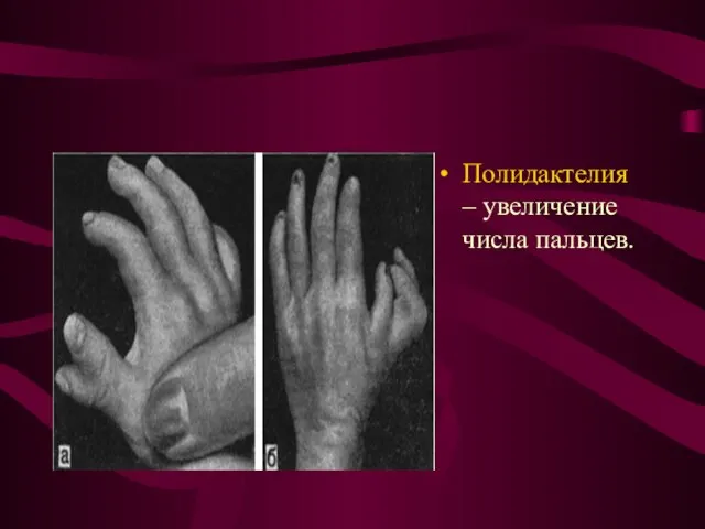 Полидактелия – увеличение числа пальцев.