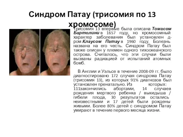 Синдром Патау (трисомия по 13 хромосоме) Трисомия 13 впервые была описана
