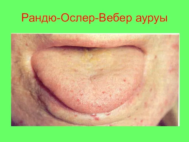 Рандю-Ослер-Вебер ауруы