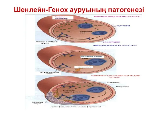 Шенлейн-Генох ауруының патогенезі