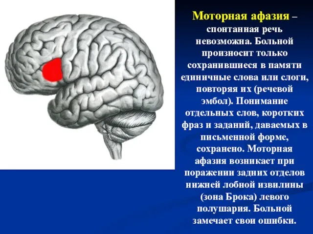 Моторная афазия – спонтанная речь невозможна. Больной произносит только сохранившиеся в