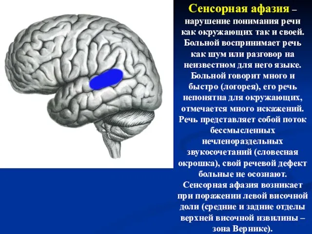 Сенсорная афазия – нарушение понимания речи как окружающих так и своей.