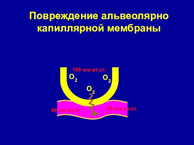 Повреждение альвеолярно капиллярной мембраны О2 О2 О2 100 мм рт.ст. 40 мм рт.ст. 60 мм рт.ст.