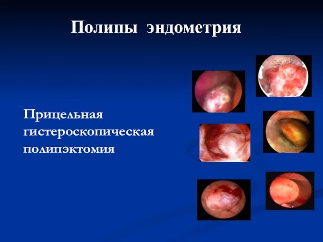 Полипы эндометрия Прицельная гистероскопическая полипэктомия