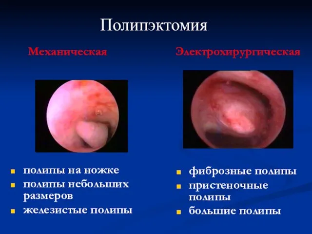 полипы на ножке полипы небольших размеров железистые полипы фиброзные полипы пристеночные