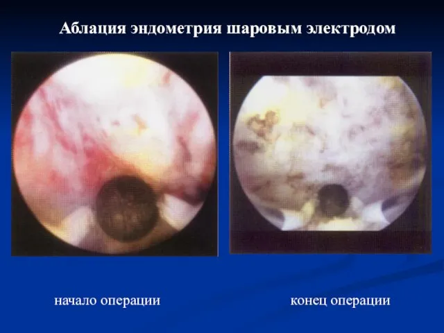 Аблация эндометрия шаровым электродом начало операции конец операции