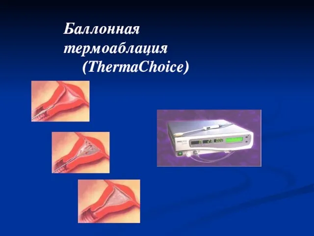 Баллонная термоаблация (ThermaChoice)