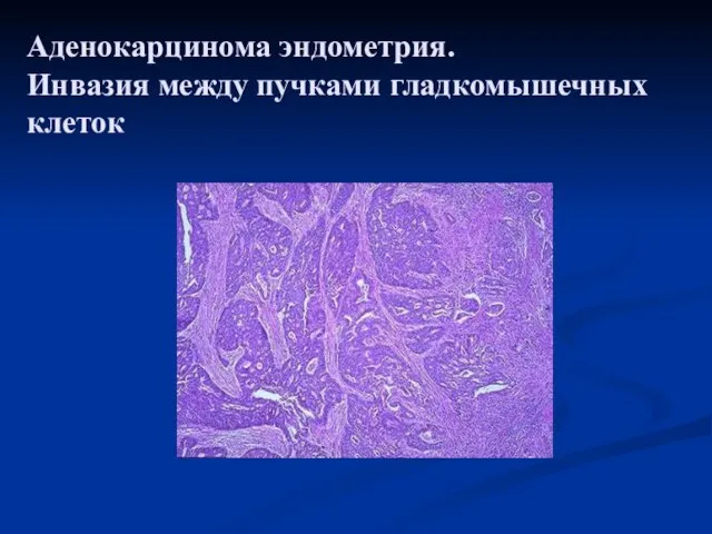 Аденокарцинома эндометрия. Инвазия между пучками гладкомышечных клеток