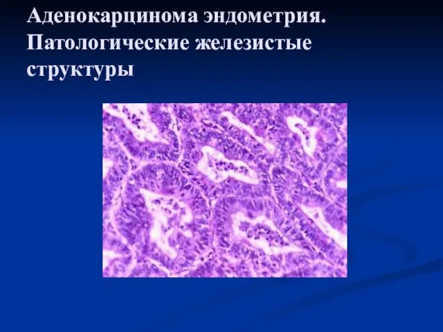 Аденокарцинома эндометрия. Патологические железистые структуры