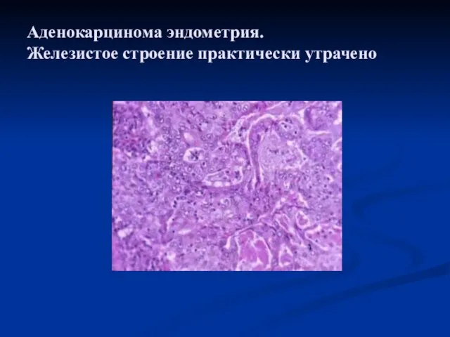 Аденокарцинома эндометрия. Железистое строение практически утрачено