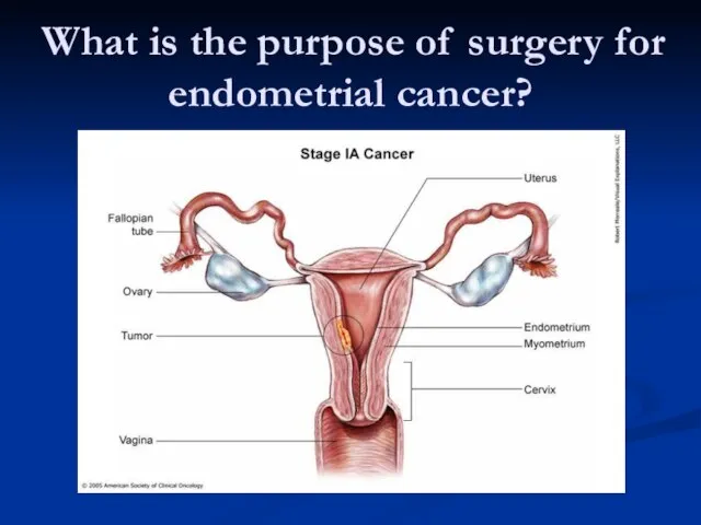 What is the purpose of surgery for endometrial cancer?