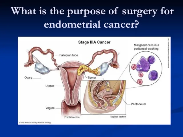 What is the purpose of surgery for endometrial cancer?