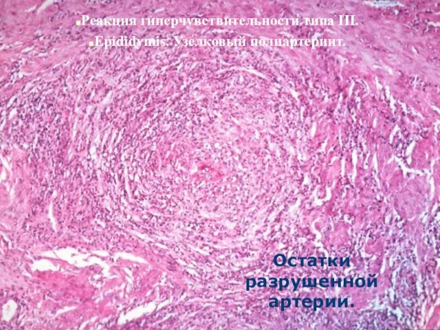 Реакция гиперчувствительности типа III. Epididymis. Узелковый полиартериит. Реакция гиперчувствительности типа III.