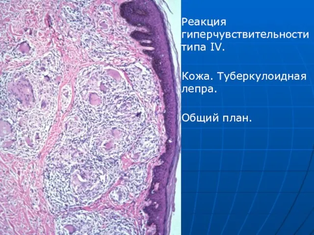 Реакция гиперчувствительности типа IV. Кожа. Туберкулоидная лепра. Общий план.