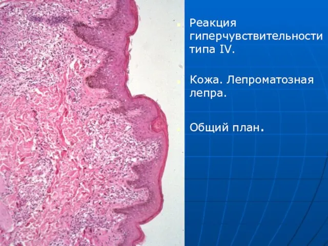 Реакция гиперчувствительности типа IV. Кожа. Лепроматозная лепра. Общий план.