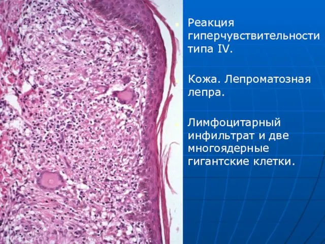 Реакция гиперчувствительности типа IV. Кожа. Лепроматозная лепра. Лимфоцитарный инфильтрат и две многоядерные гигантские клетки.