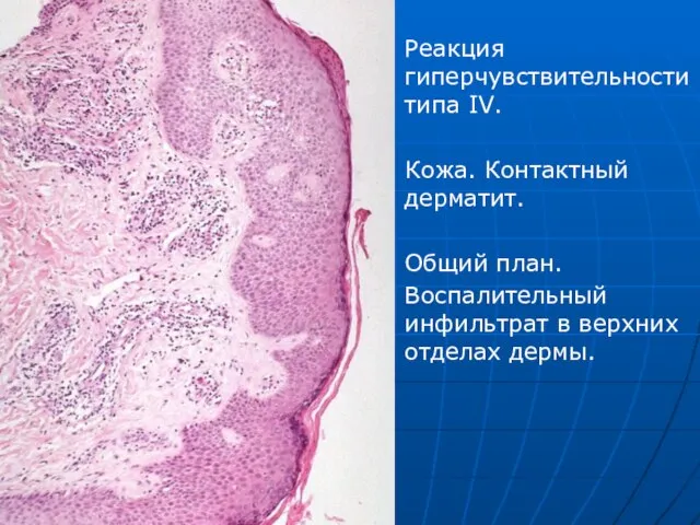 Реакция гиперчувствительности типа IV. Кожа. Контактный дерматит. Общий план. Воспалительный инфильтрат в верхних отделах дермы.