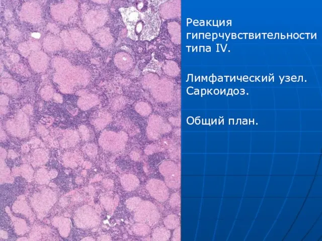 Реакция гиперчувствительности типа IV. Лимфатический узел. Саркоидоз. Общий план.