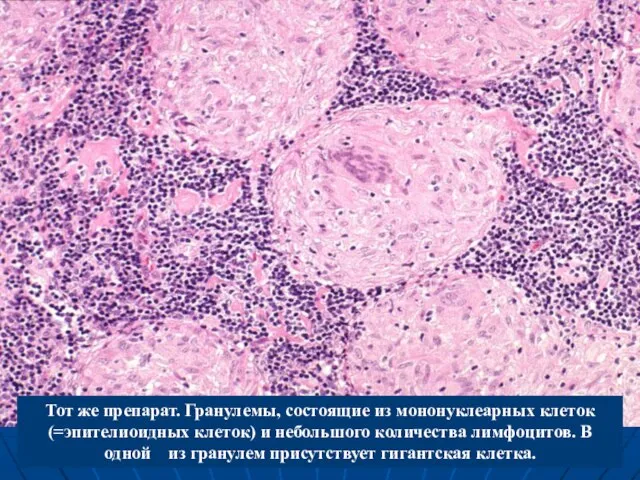 Тот же препарат. Гранулемы, состоящие из мононуклеарных клеток (=эпителиоидных клеток) и