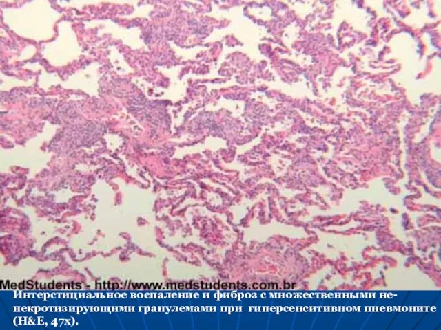 Интерстициальное воспаление и фиброз с множественными не-некротизирующими гранулемами при гиперсенситивном пневмоните (H&E, 47x).