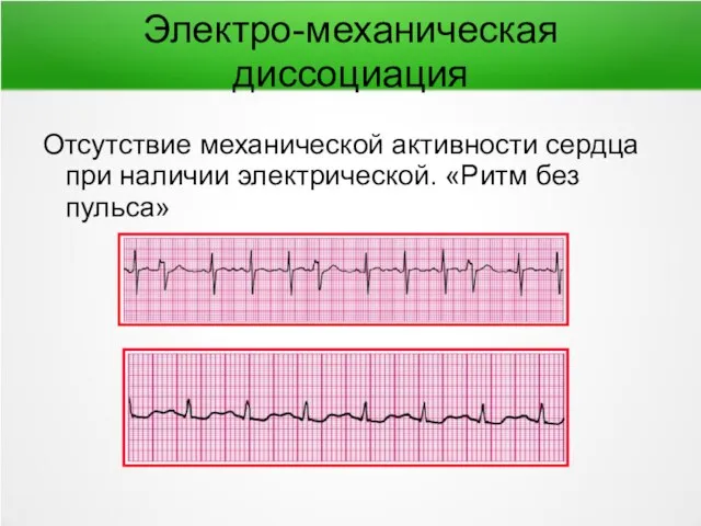 Электро-механическая диссоциация Отсутствие механической активности сердца при наличии электрической. «Ритм без пульса»