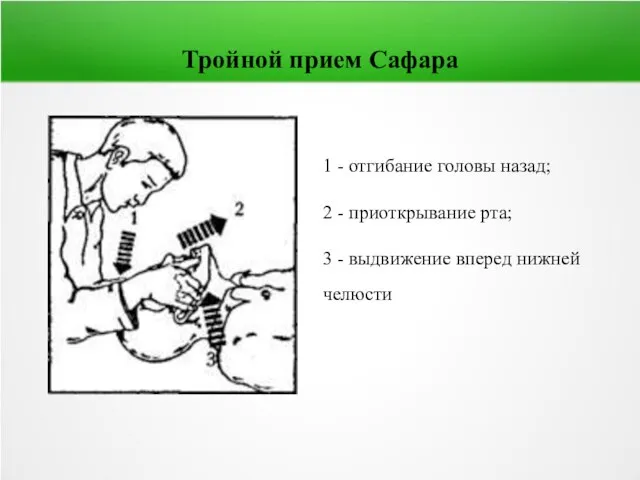 Тройной прием Сафара 1 - отгибание головы назад; 2 - приоткрывание