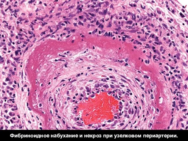 Фибриноидное набухание и некроз при узелковом периартерии.