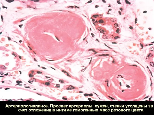 Артериологиалиноз. Просвет артериолы сужен, стенки утолщены за счет отложения в интиме гомогенных масс розового цвета.