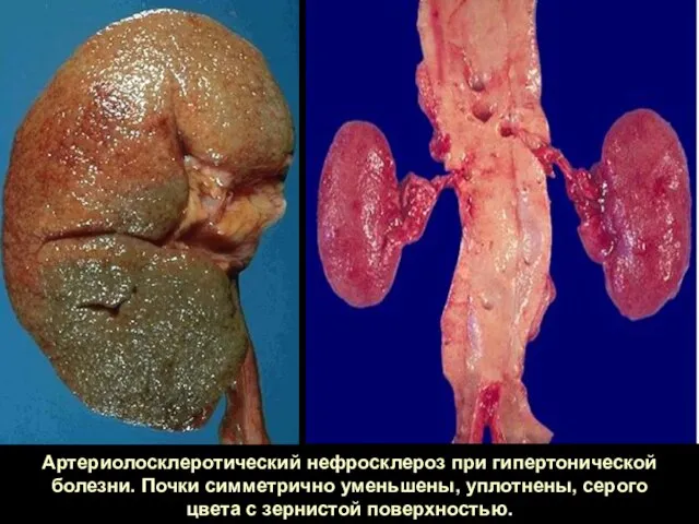 Артериолосклеротический нефросклероз при гипертонической болезни. Почки симметрично уменьшены, уплотнены, серого цвета с зернистой поверхностью.