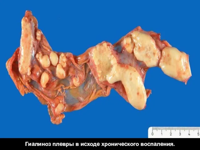 Гиалиноз плевры в исходе хронического воспаления.