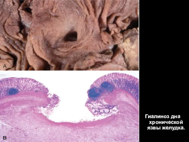 Гиалиноз дна хроническо й язвы желудка.