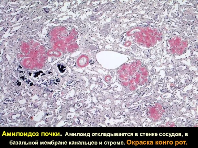 Амилоидоз почки. Амилоид откладывается в стенке сосудов, в базальной мембране канальцев и строме. Окраска конго рот.