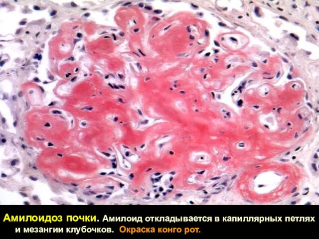 Амилоидоз почки. Амилоид откладывается в капиллярных петлях и мезангии клубочков. Окраска конго рот.