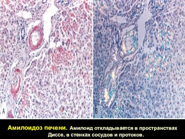 Амилоидоз печени. Амилоид откладывается в пространствах Диссе, в стенках сосудов и протоков.