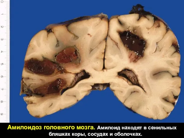 Амилоидоз головного мозга. Амилоид находят в сенильных бляшках коры, сосудах и оболочках.