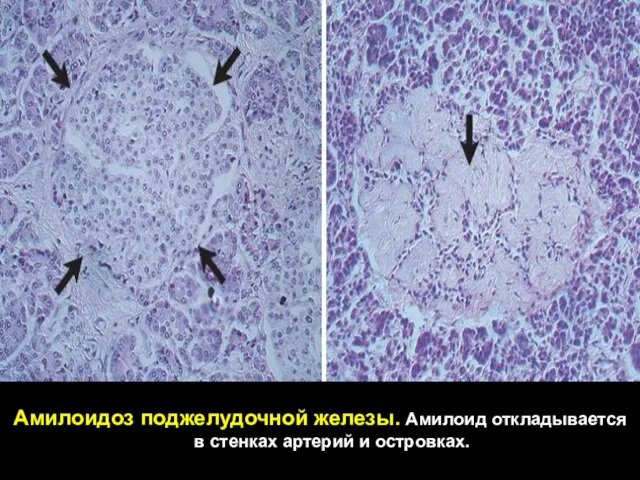 Амилоидоз поджелудочной железы. Амилоид откладывается в стенках артерий и островках.