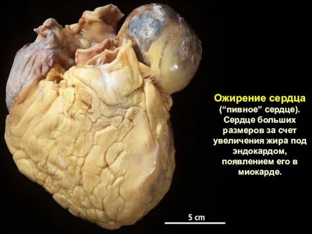 Ожирение сердца (“пивное” сердце). Сердце больших размеров за счет увеличения жира