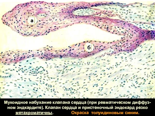 Мукоидное набухание клапана сердца (при ревматическом диффуз-ном эндкардите). Клапан сердца и