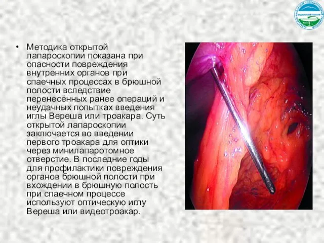 Методика открытой лапароскопии показана при опасности повреждения внутренних органов при спаечных