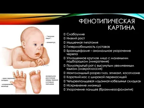 ФЕНОТИПИЧЕСКАЯ КАРТИНА Слабоумие Низкий рост Мышечная гипотония Гипермобильность суставов Брахицефалия –