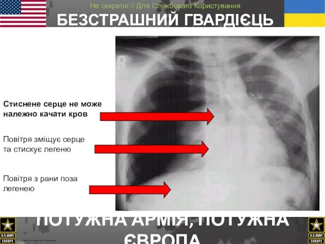 Повітря зміщує серце та стискує легеню Стиснене серце не може належно