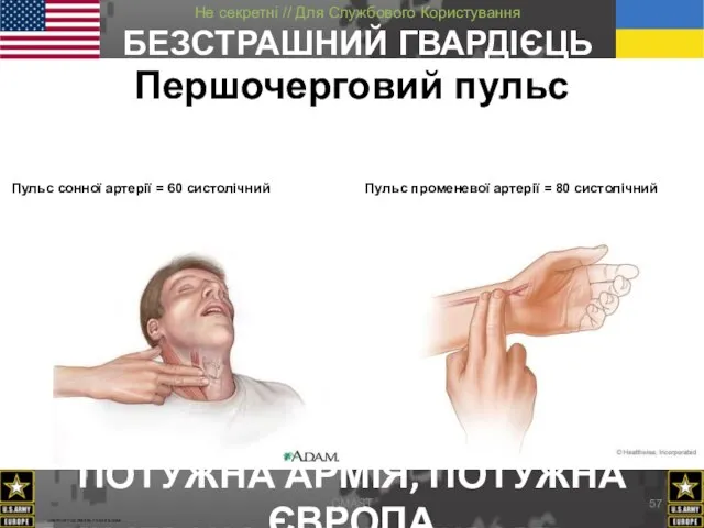 Першочерговий пульс Пульс сонної артерії = 60 систолічний Пульс променевої артерії = 80 систолічний CMAST