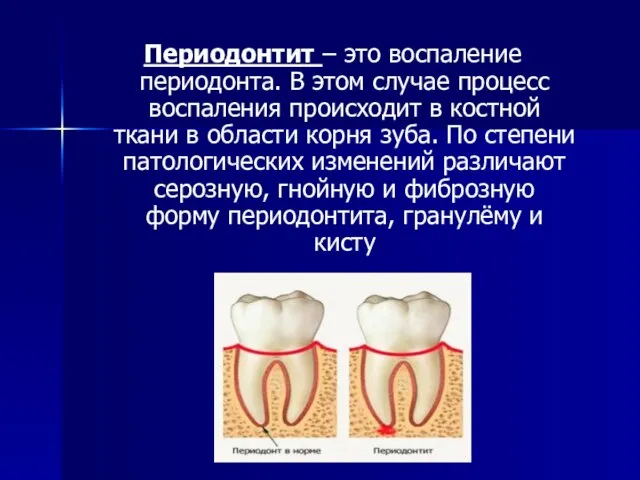 Периодонтит – это воспаление периодонта. В этом случае процесс воспаления происходит